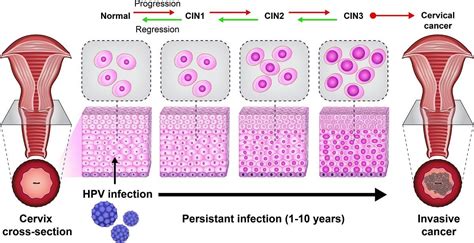 hpv 痣|HPV